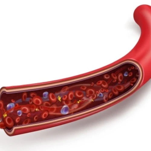 Colesterolo e arteriosclerosi