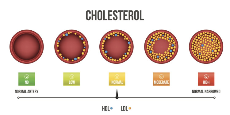 Figura 2: Ruolo del colesterolo HDL e LDL nell'ispessimento dei vasi sanguigni.4