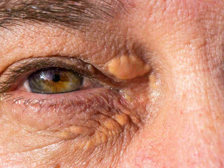 occhi di un uomo xantelasmi alla palpebra per ipercolesterolemia
